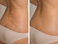 Waist Cellulite