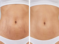 Abdominal Stretch Marks