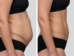 Diastasis Recti
